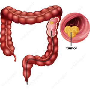 وکتور کلونوسکوپی سرطان روده بزرگ