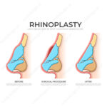 طرح اینفوگرافی رینوپلاستی