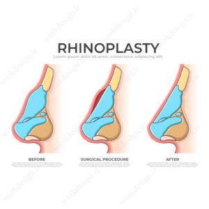 طرح اینفوگرافی رینوپلاستی