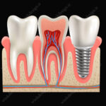 وکتور ایمپلنت دندان سه بعدی