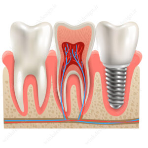 وکتور ایمپلنت دندان سه بعدی
